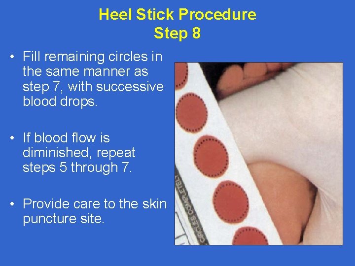 Heel Stick Procedure Step 8 • Fill remaining circles in the same manner as