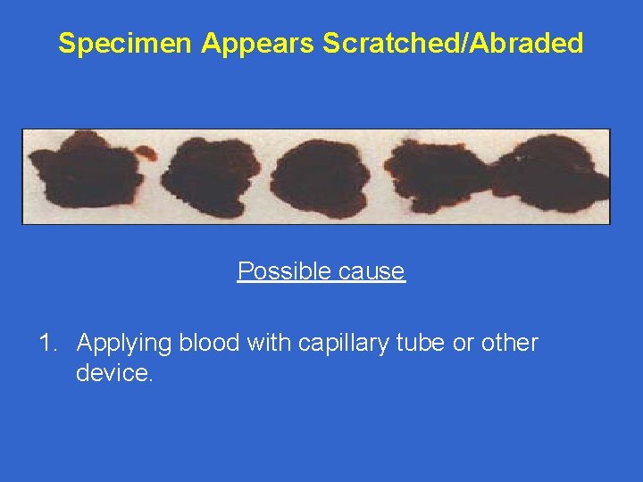 Specimen Appears Scratched/Abraded Possible cause 1. Applying blood with capillary tube or other device.