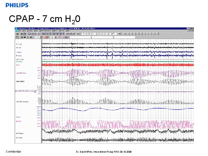 CPAP - 7 cm H 20 Confidential Dr. David White, International Group HHS, 09.