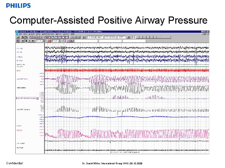 Computer-Assisted Positive Airway Pressure Confidential Dr. David White, International Group HHS, 09. 10. 2009