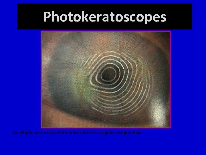 Photokeratoscopes No elliptic distortion of the mires due to irregular astigmatism 