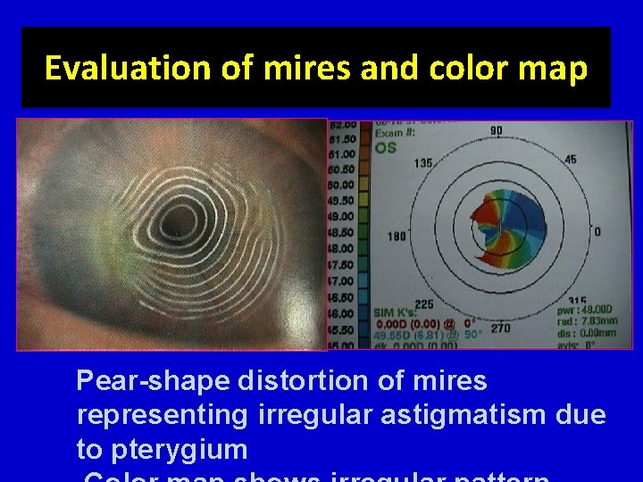 Evaluation of mires and color map Pear-shape distortion of mires representing irregular astigmatism due