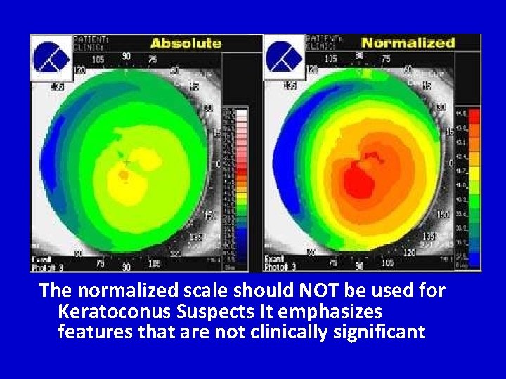 The normalized scale should NOT be used for Keratoconus Suspects It emphasizes features that