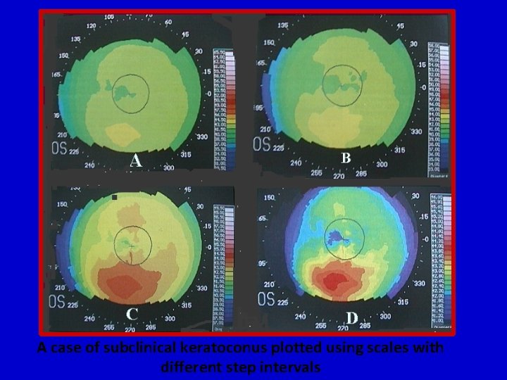 A case of subclinical keratoconus plotted using scales with different step intervals 