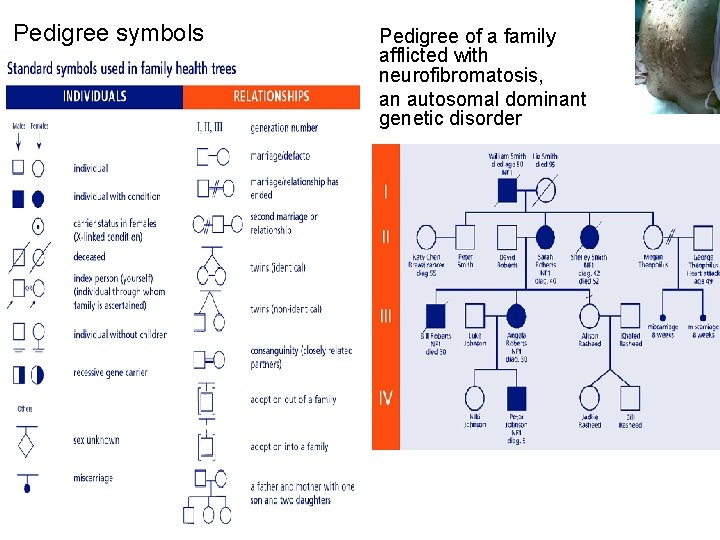 Pedigree symbols Pedigree of a family afflicted with neurofibromatosis, an autosomal dominant genetic disorder
