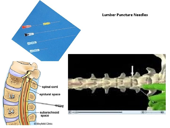Lumber Puncture Needles 
