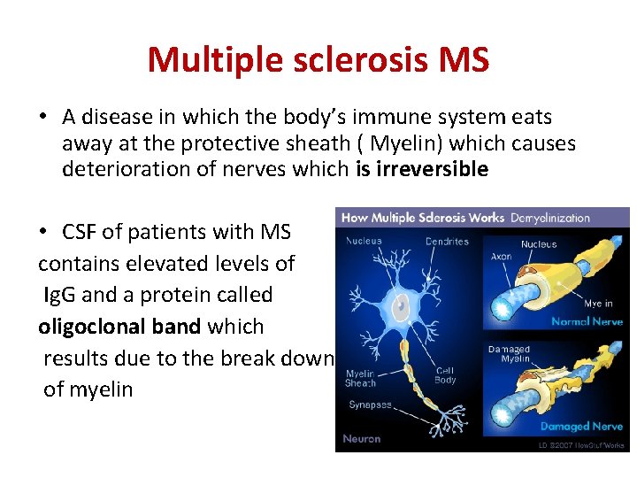 Multiple sclerosis MS • A disease in which the body’s immune system eats away