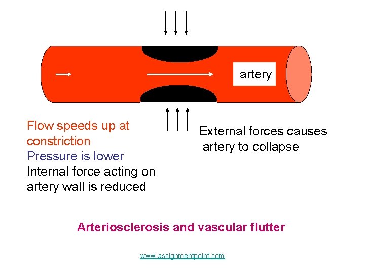 artery Flow speeds up at constriction Pressure is lower Internal force acting on artery