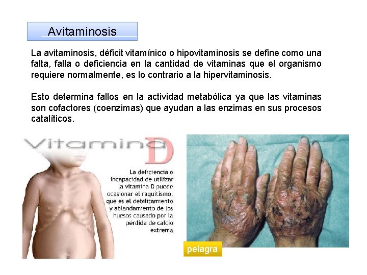 Avitaminosis La avitaminosis, déficit vitamínico o hipovitaminosis se define como una falta, falla o