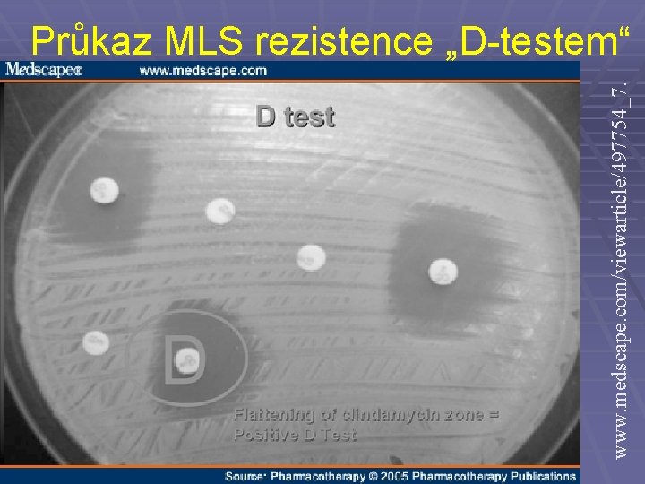 www. medscape. com/viewarticle/497754_7. Průkaz MLS rezistence „D-testem“ 