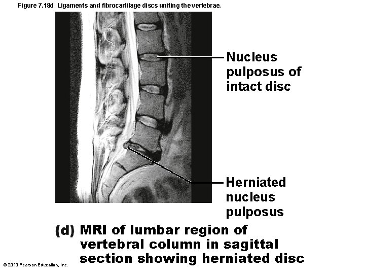 Figure 7. 18 d Ligaments and fibrocartilage discs uniting the vertebrae. Nucleus pulposus of