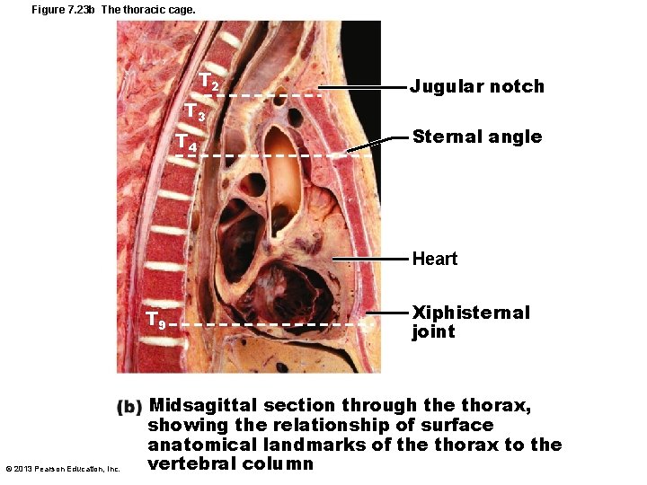 Figure 7. 23 b The thoracic cage. T 2 T 3 T 4 Jugular