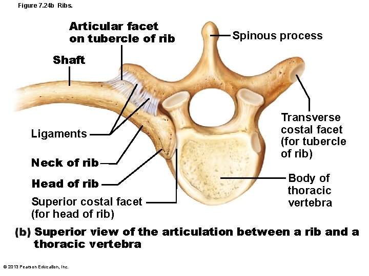 Figure 7. 24 b Ribs. Articular facet on tubercle of rib Spinous process Shaft