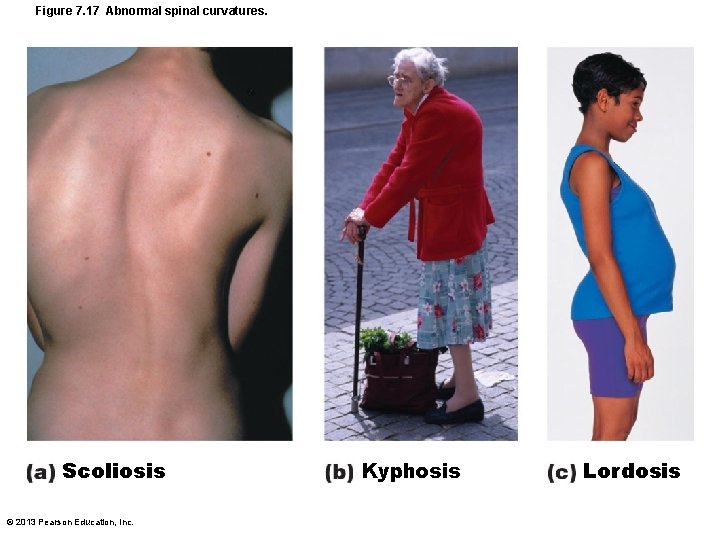 Figure 7. 17 Abnormal spinal curvatures. Scoliosis © 2013 Pearson Education, Inc. Kyphosis Lordosis