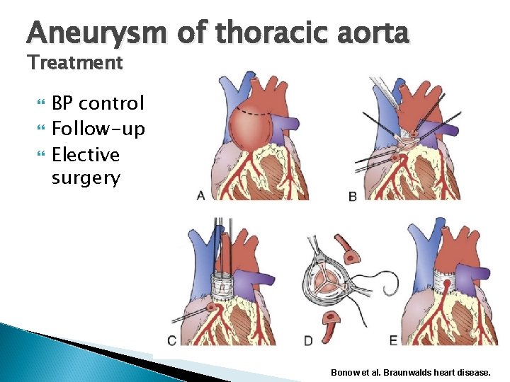 Aneurysm of thoracic aorta Treatment BP control Follow-up Elective surgery Bonow et al. Braunwalds