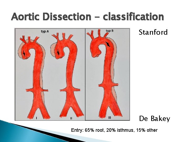 Aortic Dissection - classification Stanford De Bakey Entry: 65% root, 20% isthmus, 15% other