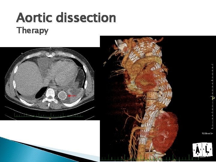 Aortic dissection Therapy 