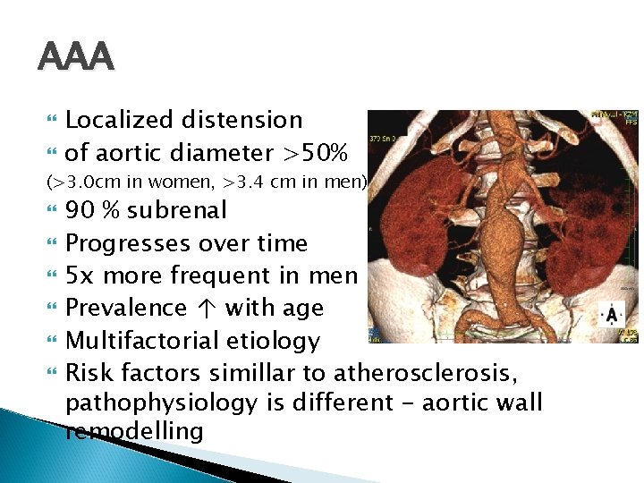 AAA Localized distension of aortic diameter >50% (>3. 0 cm in women, >3. 4