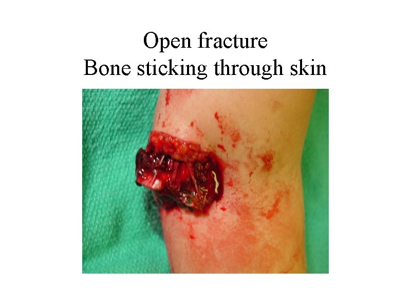 Open fracture Bone sticking through skin 