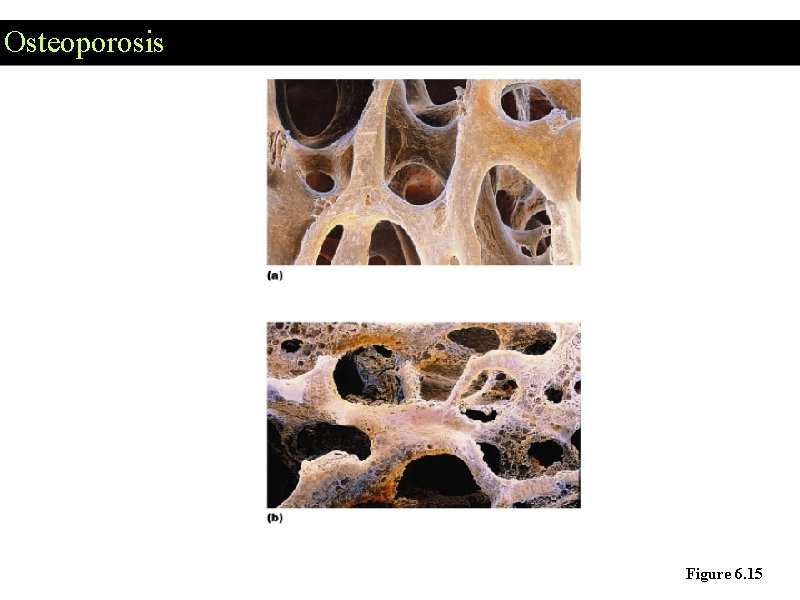 Osteoporosis Figure 6. 15 