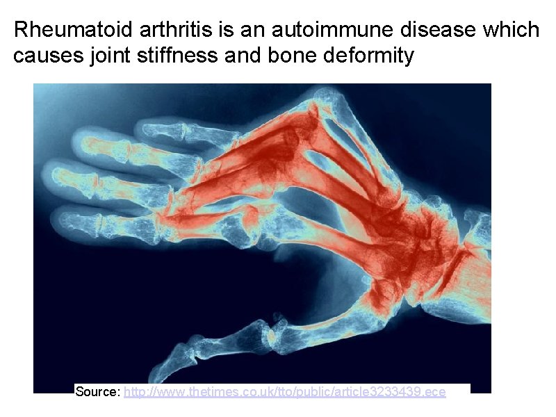 Rheumatoid arthritis is an autoimmune disease which causes joint stiffness and bone deformity Source: