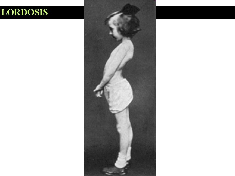 LORDOSIS 