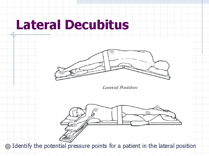 Lateral Decubitus Identify the potential pressure points for a patient in the lateral position