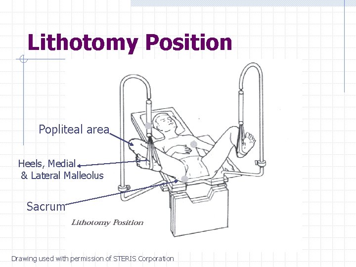 Lithotomy Position Popliteal area Heels, Medial & Lateral Malleolus Sacrum Drawing used with permission