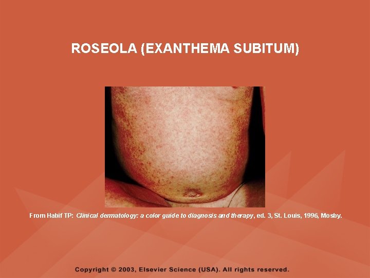 ROSEOLA (EXANTHEMA SUBITUM) From Habif TP: Clinical dermatology: a color guide to diagnosis and