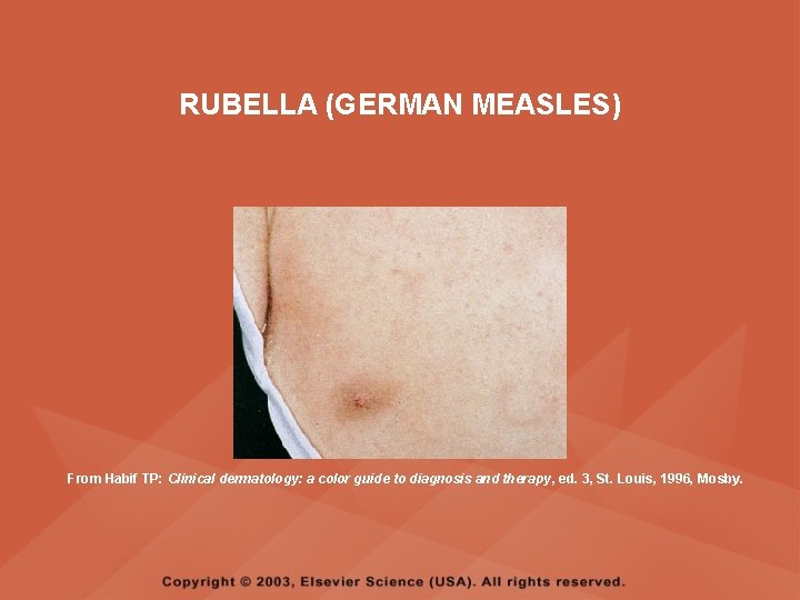 RUBELLA (GERMAN MEASLES) From Habif TP: Clinical dermatology: a color guide to diagnosis and