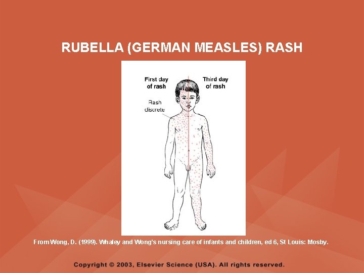 RUBELLA (GERMAN MEASLES) RASH From Wong, D. (1999). Whaley and Wong’s nursing care of