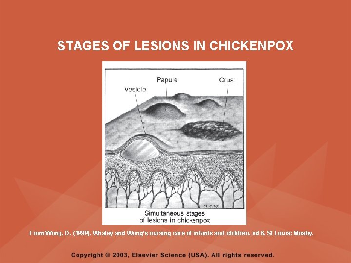 STAGES OF LESIONS IN CHICKENPOX From Wong, D. (1999). Whaley and Wong’s nursing care