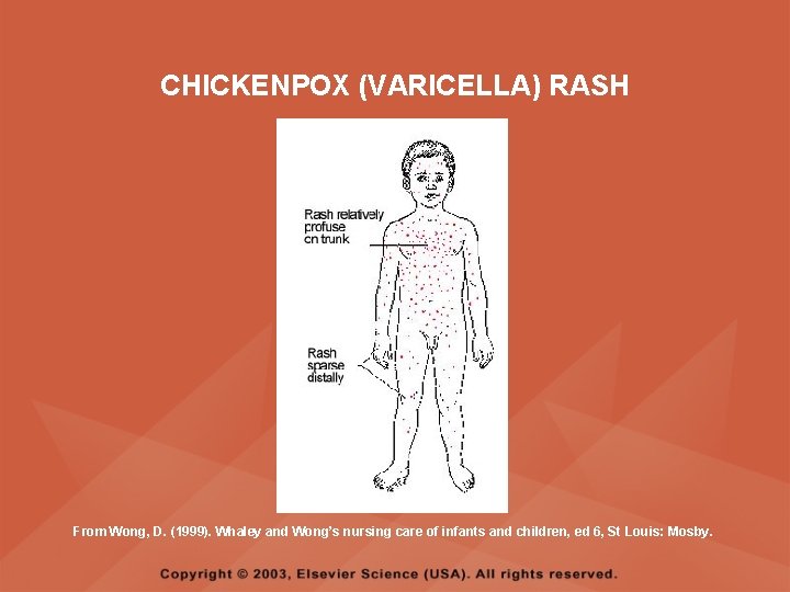 CHICKENPOX (VARICELLA) RASH From Wong, D. (1999). Whaley and Wong’s nursing care of infants