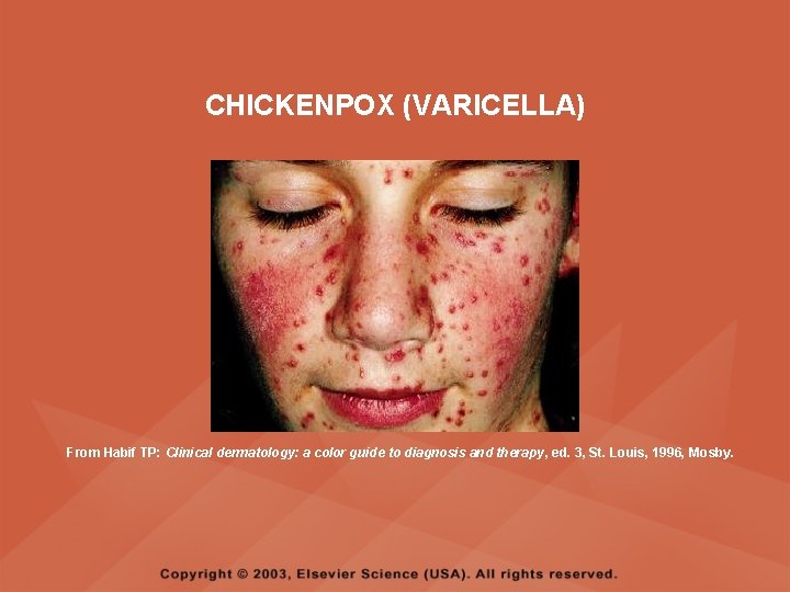 CHICKENPOX (VARICELLA) From Habif TP: Clinical dermatology: a color guide to diagnosis and therapy,