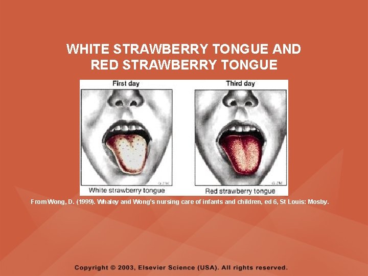 WHITE STRAWBERRY TONGUE AND RED STRAWBERRY TONGUE From Wong, D. (1999). Whaley and Wong’s