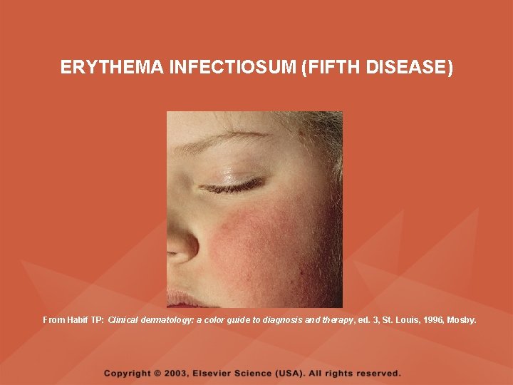 ERYTHEMA INFECTIOSUM (FIFTH DISEASE) From Habif TP: Clinical dermatology: a color guide to diagnosis