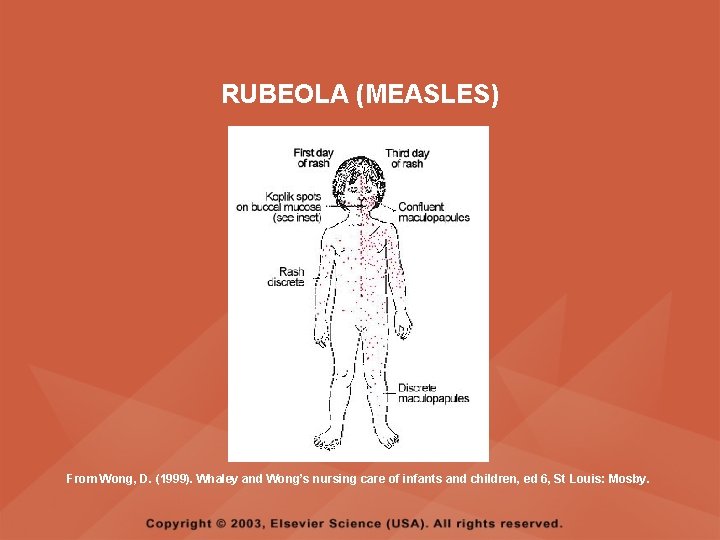 RUBEOLA (MEASLES) From Wong, D. (1999). Whaley and Wong’s nursing care of infants and