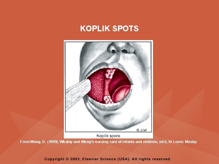 KOPLIK SPOTS From Wong, D. (1999). Whaley and Wong’s nursing care of infants and