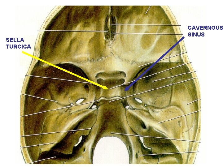 SELLA TURCICA CAVERNOUS SINUS 