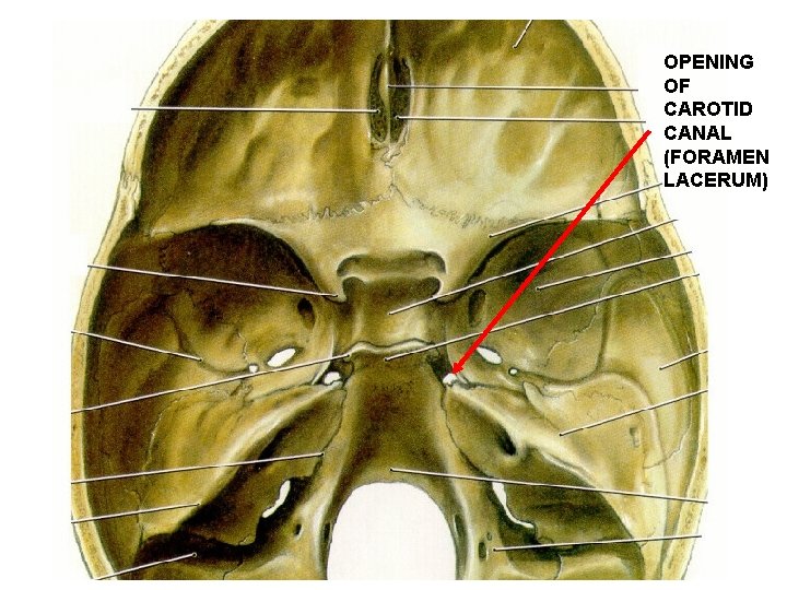 OPENING OF CAROTID CANAL (FORAMEN LACERUM) 