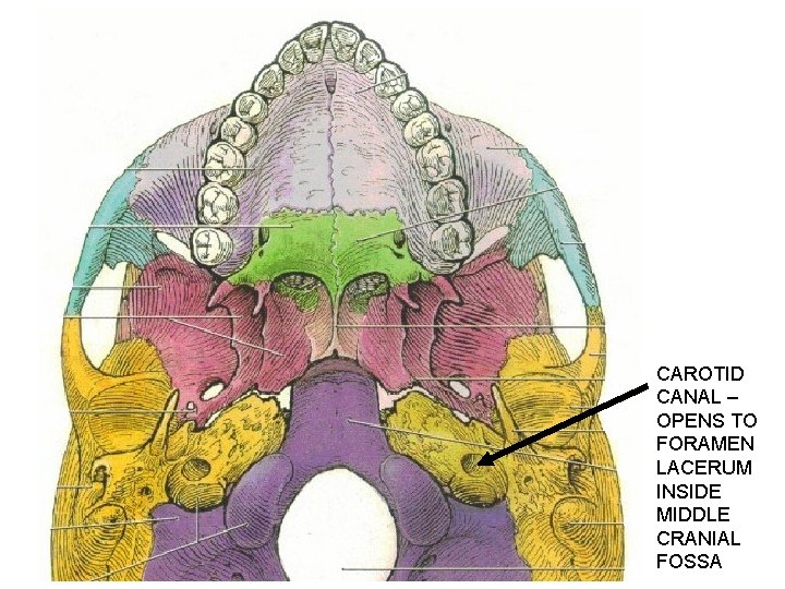 CAROTID CANAL – OPENS TO FORAMEN LACERUM INSIDE MIDDLE CRANIAL FOSSA 