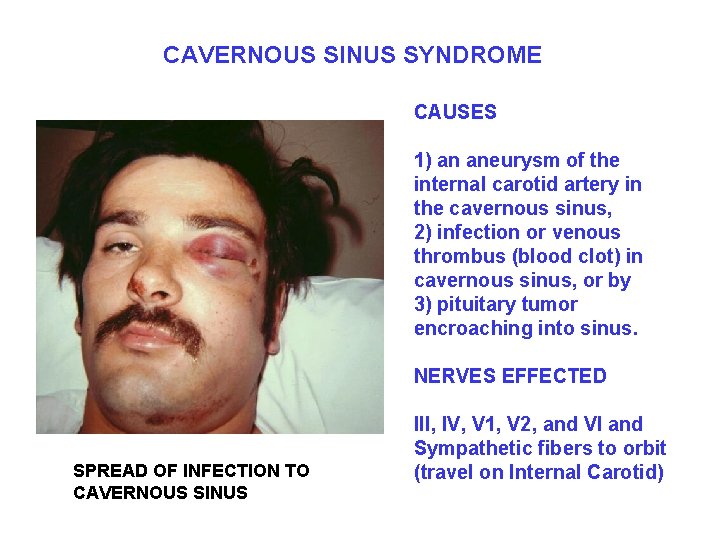 CAVERNOUS SINUS SYNDROME CAUSES 1) an aneurysm of the internal carotid artery in the