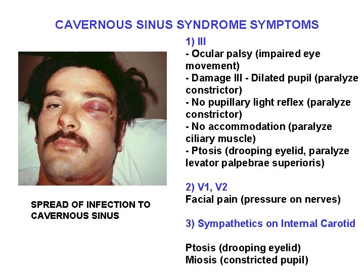 CAVERNOUS SINUS SYNDROME SYMPTOMS 1) III - Ocular palsy (impaired eye movement) - Damage