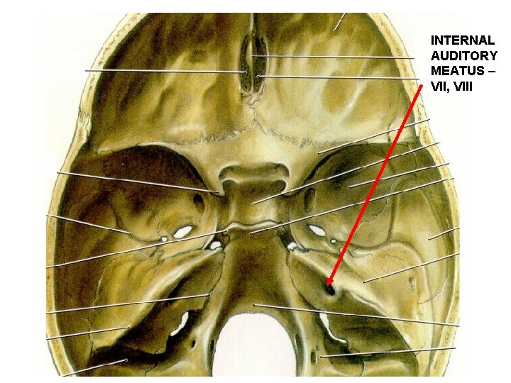 INTERNAL AUDITORY MEATUS – VII, VIII 