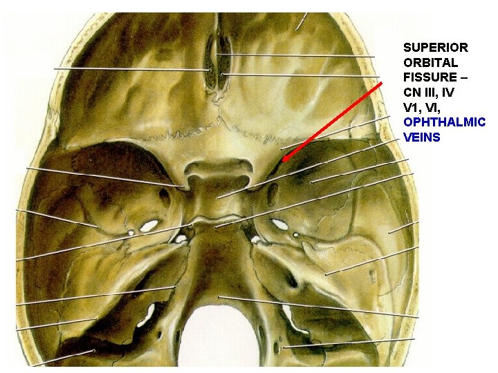 SUPERIOR ORBITAL FISSURE – CN III, IV V 1, VI, OPHTHALMIC VEINS 