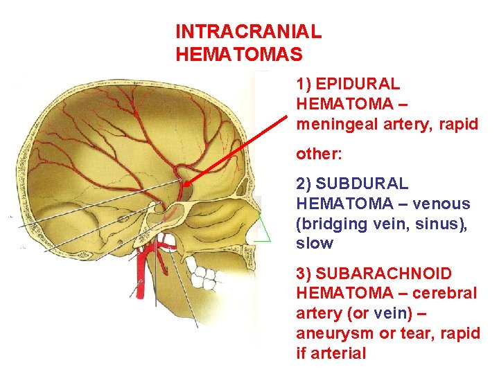 INTRACRANIAL HEMATOMAS 1) EPIDURAL HEMATOMA – meningeal artery, rapid other: 2) SUBDURAL HEMATOMA –