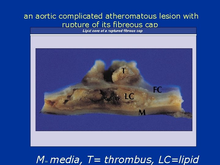 an aortic complicated atheromatous lesion with rupture of its fibreous cap M= media, T=