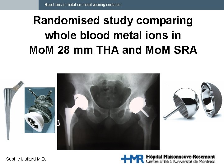 Blood ions in metal-on-metal bearing surfaces Randomised study comparing whole blood metal ions in