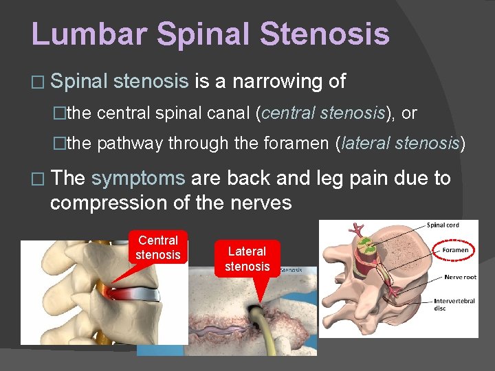 Lumbar Spinal Stenosis � Spinal stenosis is a narrowing of �the central spinal canal