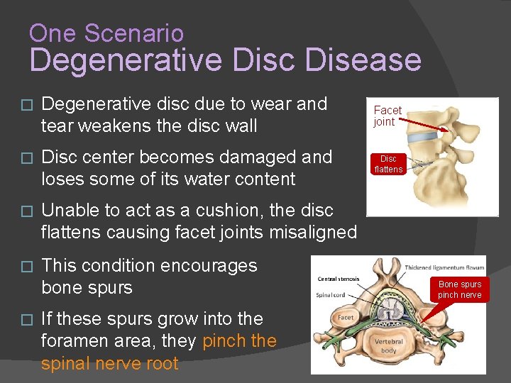 One Scenario Degenerative Disc Disease � Degenerative disc due to wear and tear weakens